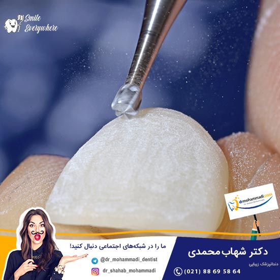 موکاپ (Mock up) چیست و چگونه در لمینت دندان استفاده می شود؟ - کلینیک دندانپزشکی دکتر شهاب محمدی
